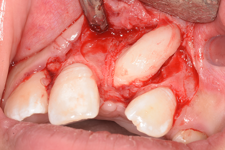 avulsion d'une dent incluse avec dilacération corono-radiculaire